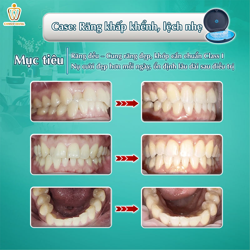Niềng Răng Có Đau Không? Giải Đáp Toàn Diện Từng Giai Đoạn Cho Người Mới Bắt Đầu 3 Niềng răng đau nhất giai đoạn nào