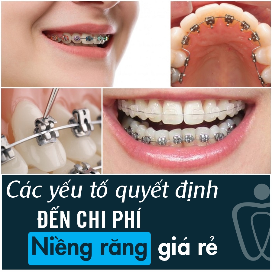Nieng Rang Gia Re Tai Chingo Dental