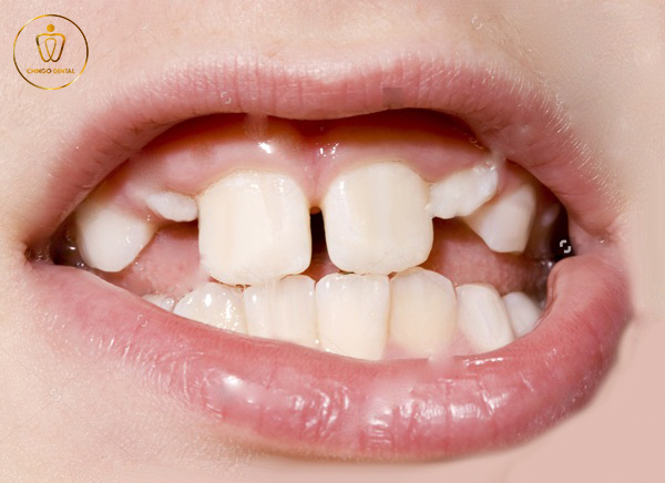 210223-Web-Chingo-En-dental-braces-2