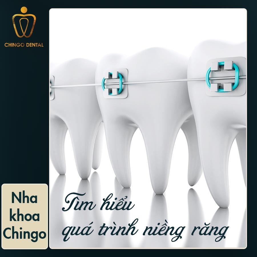 Qua Trinh Nieng Rang Chingo Dental
