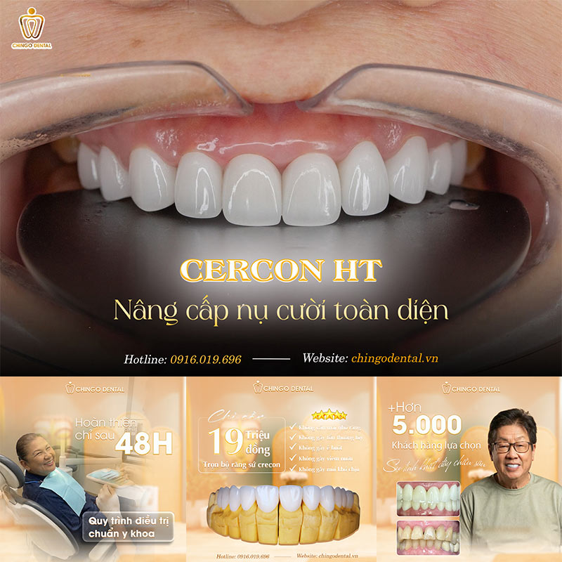 Giải Mã Sức Hút Của Răng Sứ Cercon: Lựa Chọn Vàng Cho Nụ Cười Rạng Rỡ 3 răng sứ cercon ht có tốt không