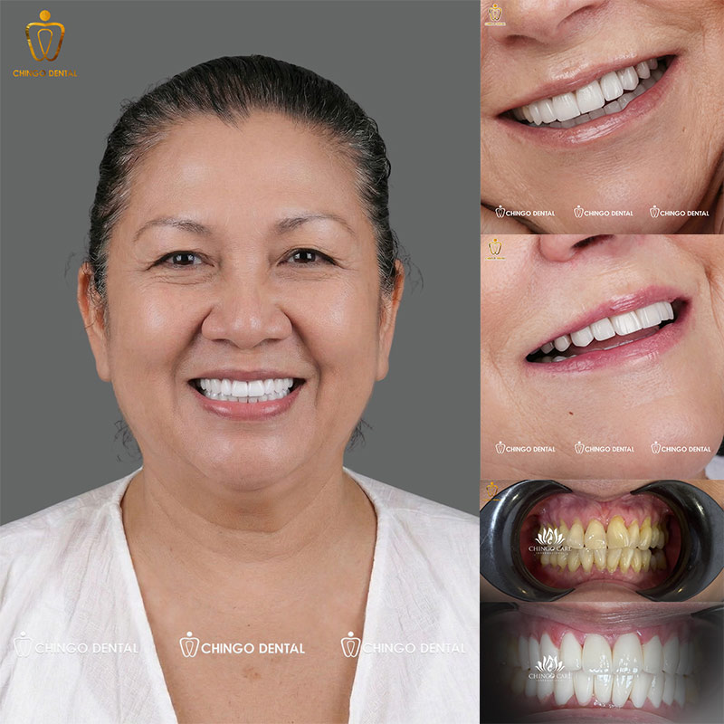 Giải Mã Sức Hút Của Răng Sứ Cercon: Lựa Chọn Vàng Cho Nụ Cười Rạng Rỡ 6 răng sứ cercon là gì