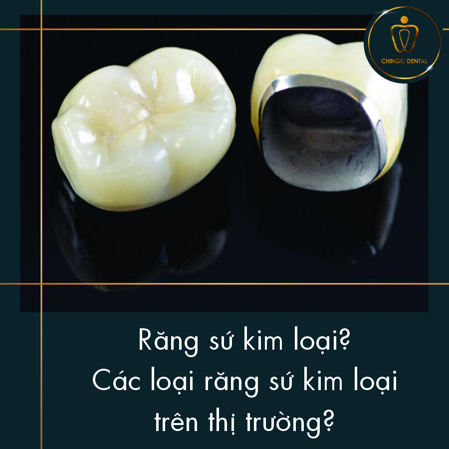 Rang Su Kim Loai Cac Dong Su Kim Loai Chingo Dental