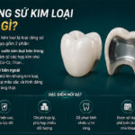 Răng Sứ Kim Loại Là Gì? 3 Loại Phổ Biến & Cách Chăm Sóc Bền Lâu răng sứ kim loại là gì