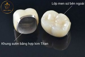 Rang Su Hop Kim Titan Chingo Dental