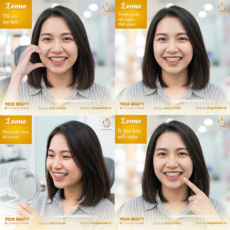 Niềng Răng Có Đau Không? Giải Đáp Toàn Diện Từng Giai Đoạn Cho Người Mới Bắt Đầu 4 Siết răng định kỳ có đau không