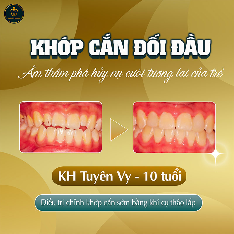 Thời Điểm Nào Thích Hợp Để Niềng Răng? Giải Đáp Toàn Diện Theo Từng Độ Tuổi 2 thời điểm nào thích hợp để niềng răng