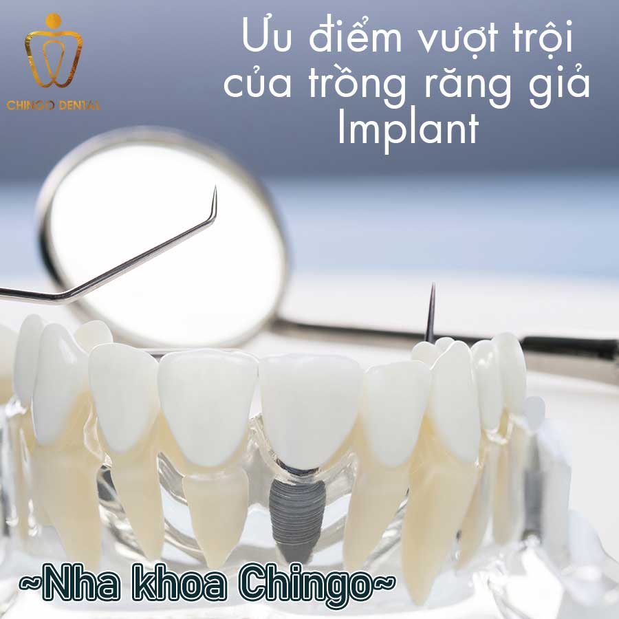 Rang Gia Implant Chingo Dental