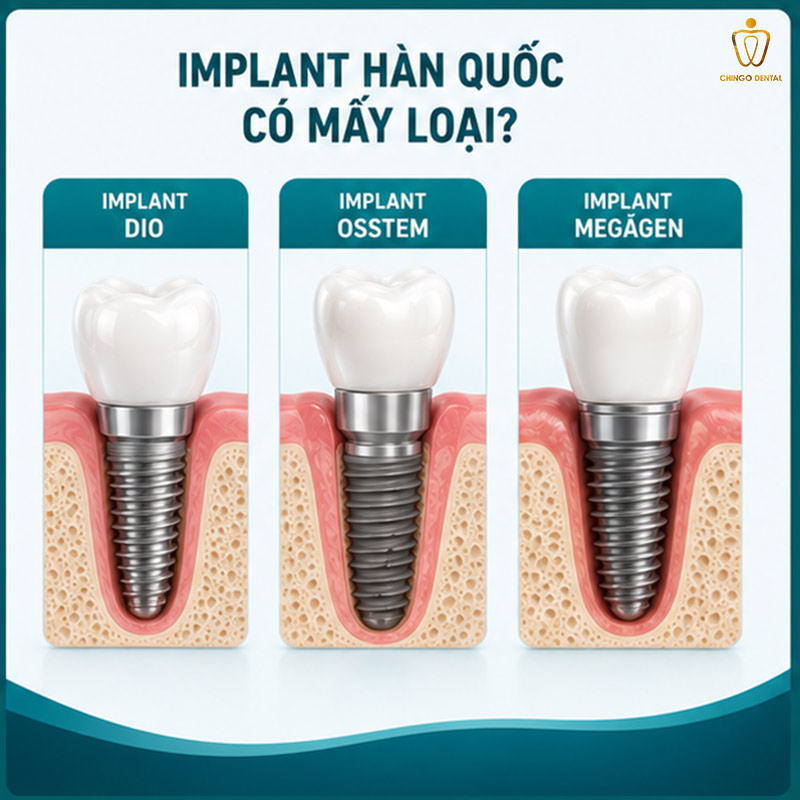 Răng Implant Hàn Quốc: Phân Loại, So Sánh Các Hãng & Bảng Giá Mới Nhất 3 các loại trụ implant