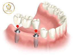 Implant Nha Khoa La Gi Chingo Dental 2