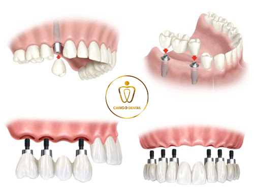 Rang Gia Implant Chingo Dental 2