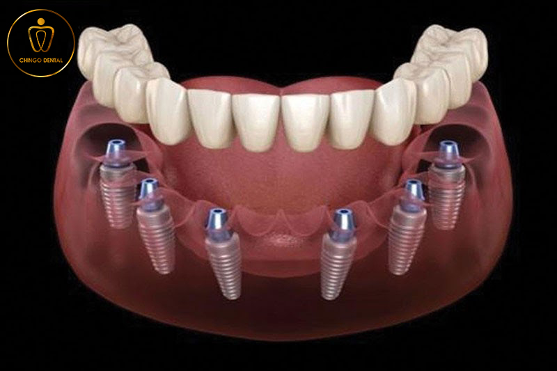 Rang Gia Implant Chingo Dental 3