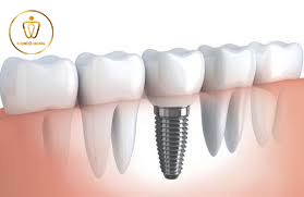 Rang Implant Han Quoc Chingo Dental 2