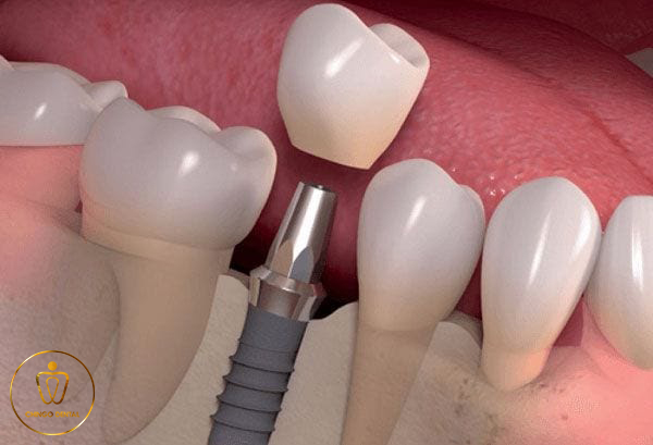 Rang Implant Han Quoc Chingo Dental 3