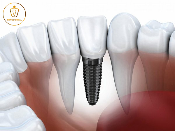 Thoi Gian Cay Ghep Implant Chingo Dental 2