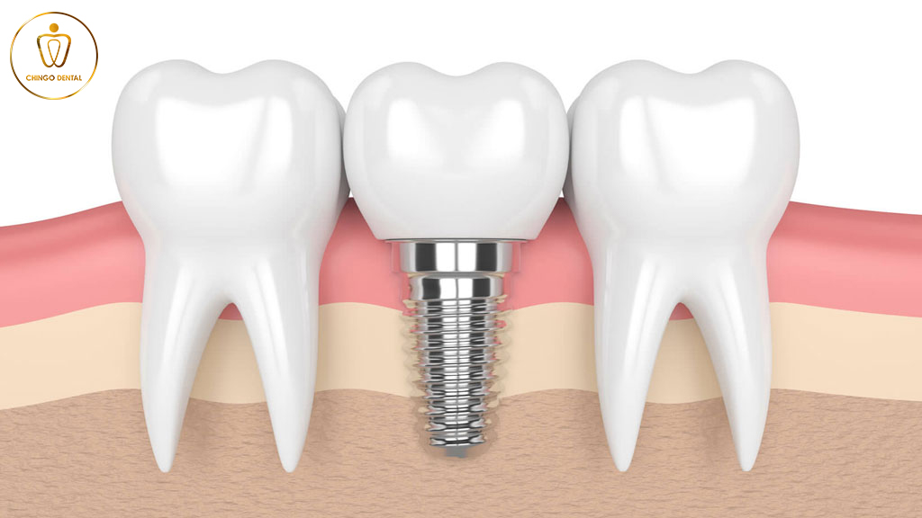 Thoi Gian Cay Ghep Implant Chingo Dental 3