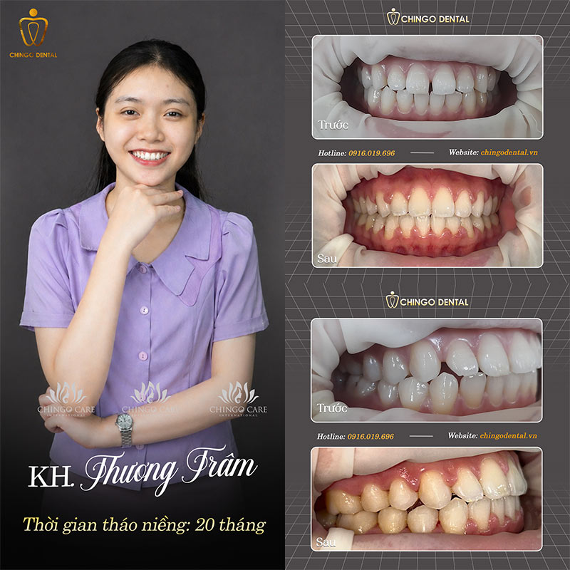 Quá Trình Niềng Răng Diễn Ra Như Thế Nào? Các Bước, Giai Đoạn & Thời Gian 4 các bước niềng răng
