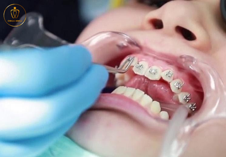 Qua Trinh Nieng Rang Ching Dental 3