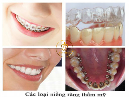 Qua Trinh Nieng Rang Chingo Dental 2