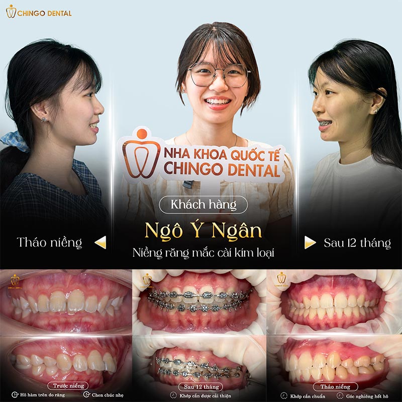 Quá Trình Niềng Răng Diễn Ra Như Thế Nào? Các Bước, Giai Đoạn & Thời Gian 1 quy trình niềng răng