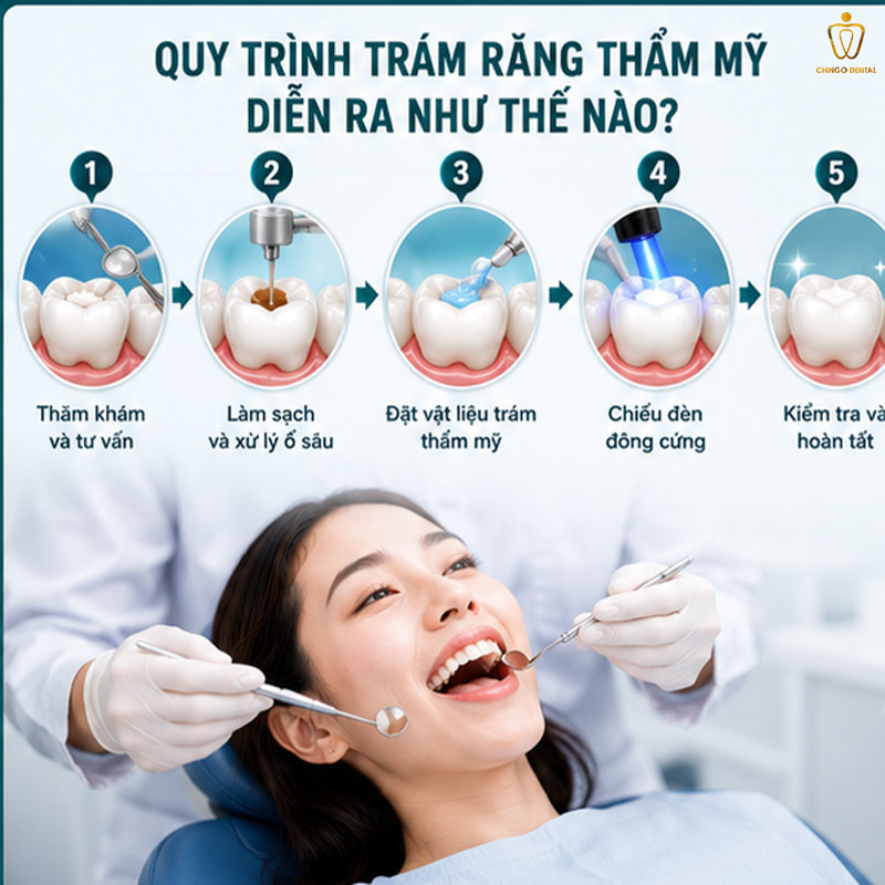 Trám Răng Thẩm Mỹ: Quy Trình, Chi Phí & Lưu Ý Quan Trọng Không Nên Bỏ Qua 3 trám răng thưa