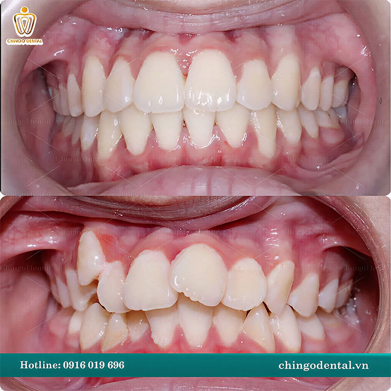 chi phí niềng răng hô nhẹ