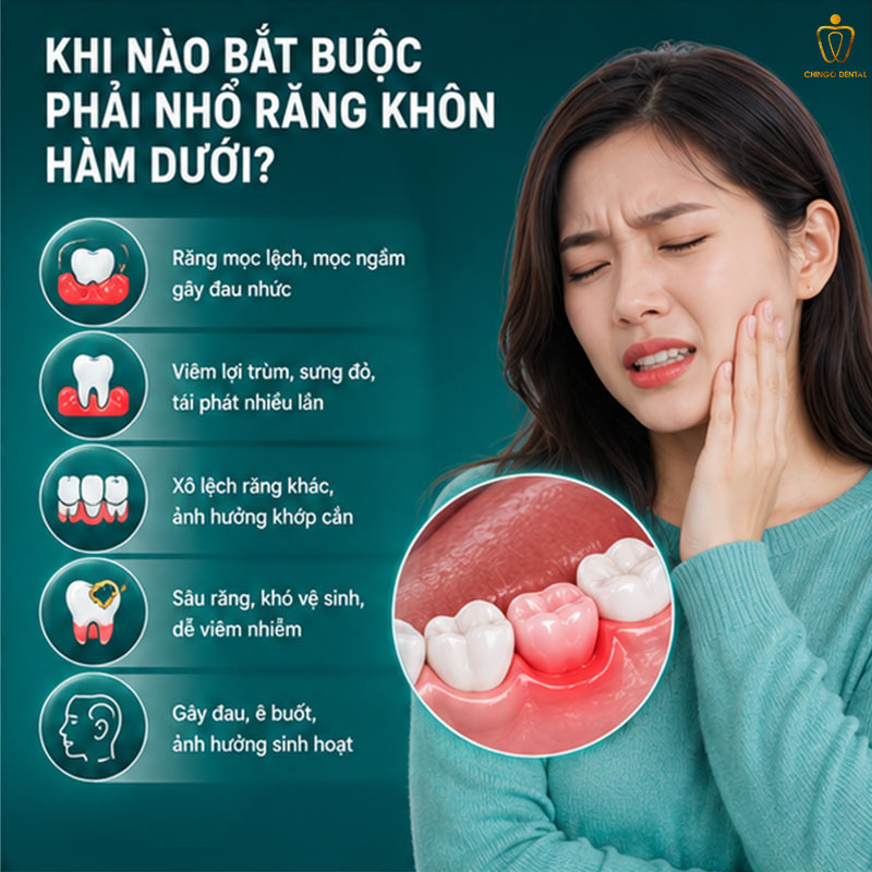 Nhổ Răng Khôn Hàm Dưới: Khi Nào Cần Nhổ, Quy Trình & Chi Phí Tại Chingo Dental 2 nhổ răng cùng hàm dưới có nguy hiểm không