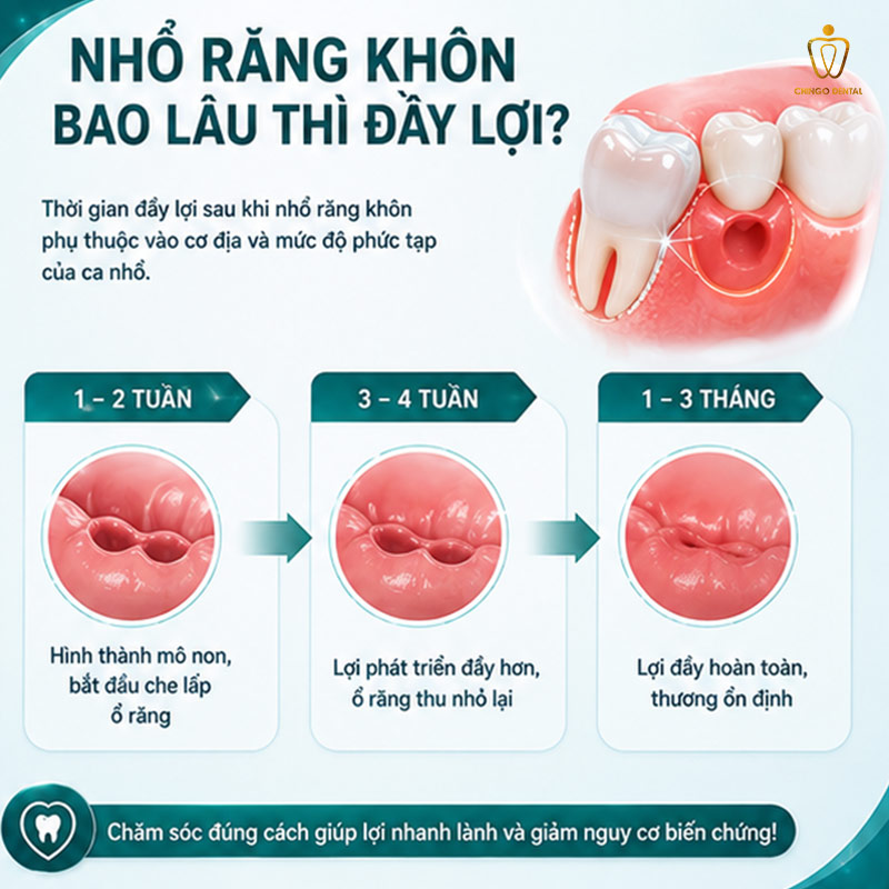 Nhổ Răng Khôn Bao Lâu Thì Lành? Toàn Bộ Thông Tin Cần Biết Trước Khi Nhổ 2 nhổ răng khôn bao lâu lành