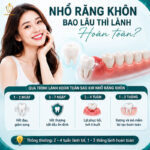 Nhổ Răng Khôn Bao Lâu Thì Lành? Toàn Bộ Thông Tin Cần Biết Trước Khi Nhổ nhổ răng khôn bao lâu thì lành