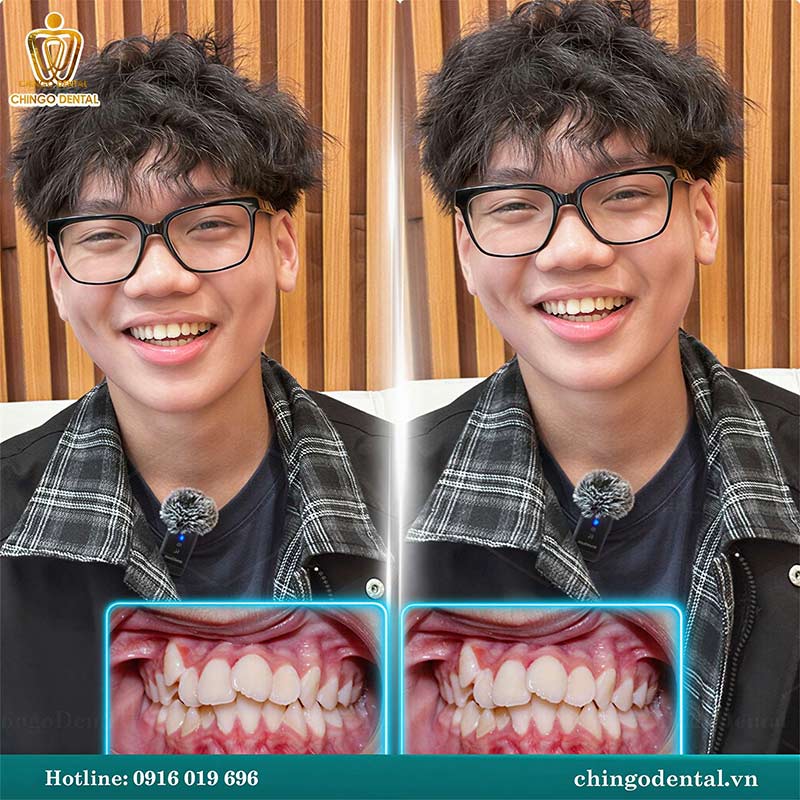 niềng răng hô mất bao lâu