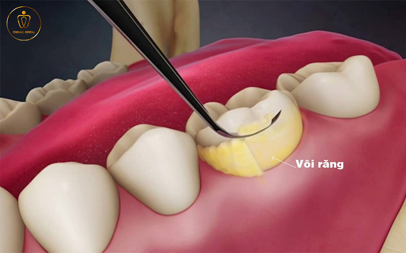 bản tin nha khoa số 4