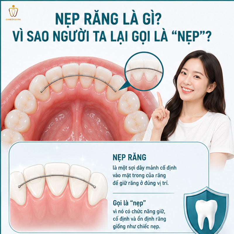 Nẹp Răng Là Gì? Các Loại, Quy Trình, Chi Phí & Những Điều Cần Biết Trước Khi Bắt Đầu 18 nẹp răng