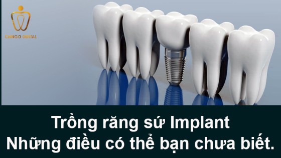 Trong Rang Su Implant Chingo Dental 4