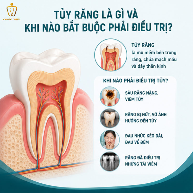 Lấy Tủy Răng Có Ảnh Hưởng Gì Không? Nha Sĩ Giải Đáp Chi Tiết 17 lấy tủy răng có ảnh hưởng gì không