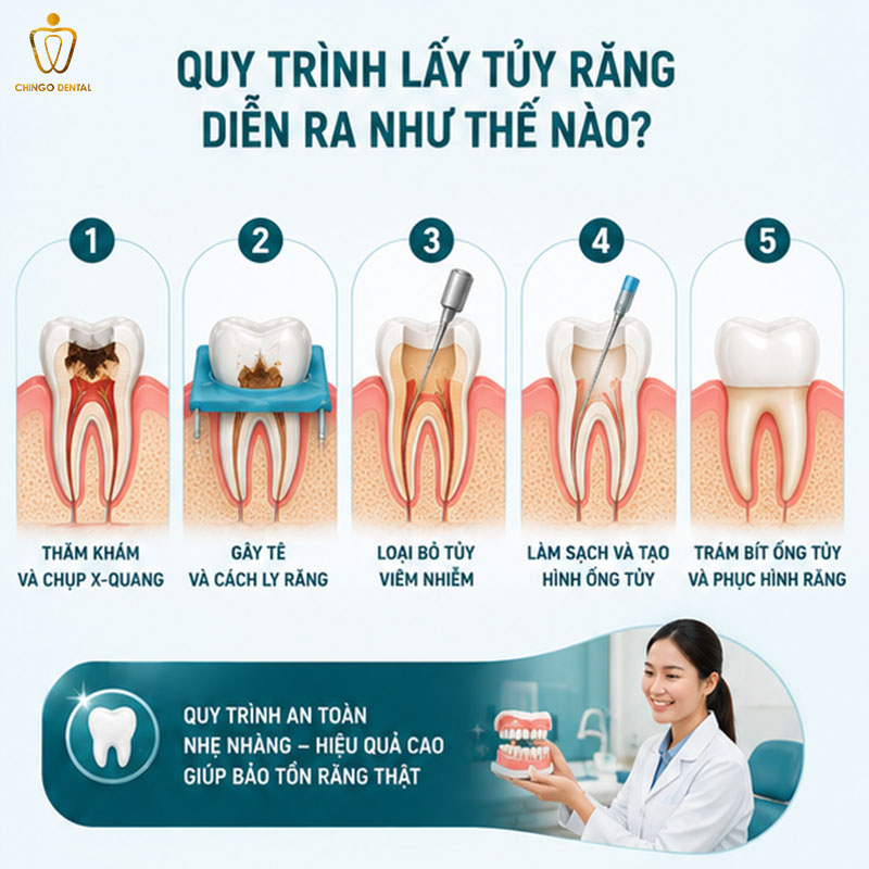 lấy tủy răng sâu
