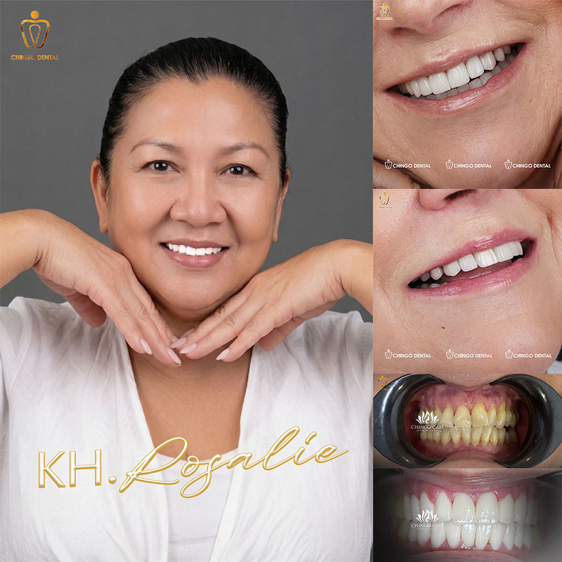 bảng giá răng sứ