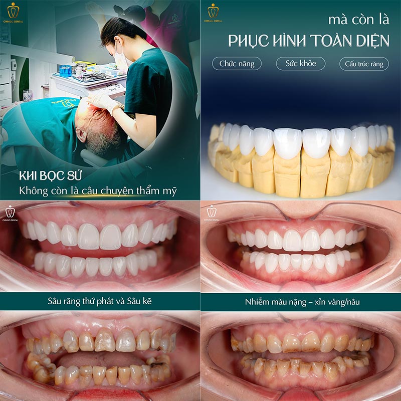 bọc răng sứ bao nhiêu tiền