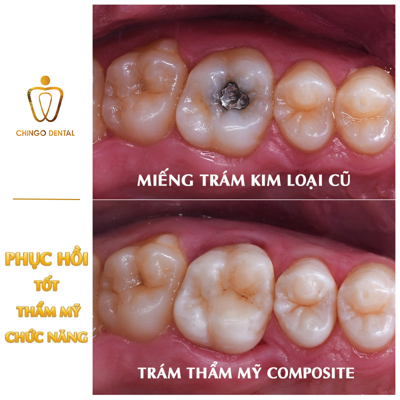 Bọc Răng Hàm Bị Sâu: Loại Sứ Nào Bền Nhất, Giá Bao Nhiêu Và Khi Nào Nên Làm? 2 bọc sứ răng hàm giá bao nhiêu