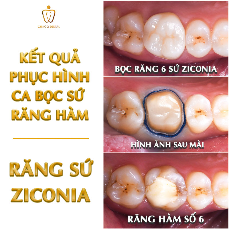 Bọc Răng Hàm Bị Sâu: Loại Sứ Nào Bền Nhất, Giá Bao Nhiêu Và Khi Nào Nên Làm? 3 bọc răng hàm
