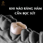 Bọc Răng Hàm Bị Sâu: Loại Sứ Nào Bền Nhất, Giá Bao Nhiêu Và Khi Nào Nên Làm? khi nào cần bọc sứ răng hàm