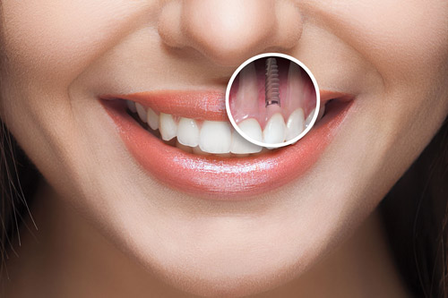 km-implant-chingo-dental