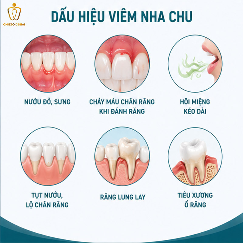 Bệnh Nha Chu Là Gì? Dấu Hiệu, Nguyên Nhân Và Cách Điều Trị Hiệu Quả 3 hình ảnh viêm nha chu