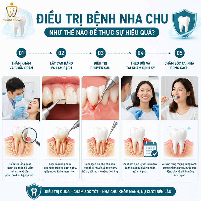 Bệnh Nha Chu Là Gì? Dấu Hiệu, Nguyên Nhân Và Cách Điều Trị Hiệu Quả 5 viêm nha chu bao lâu thì khỏi