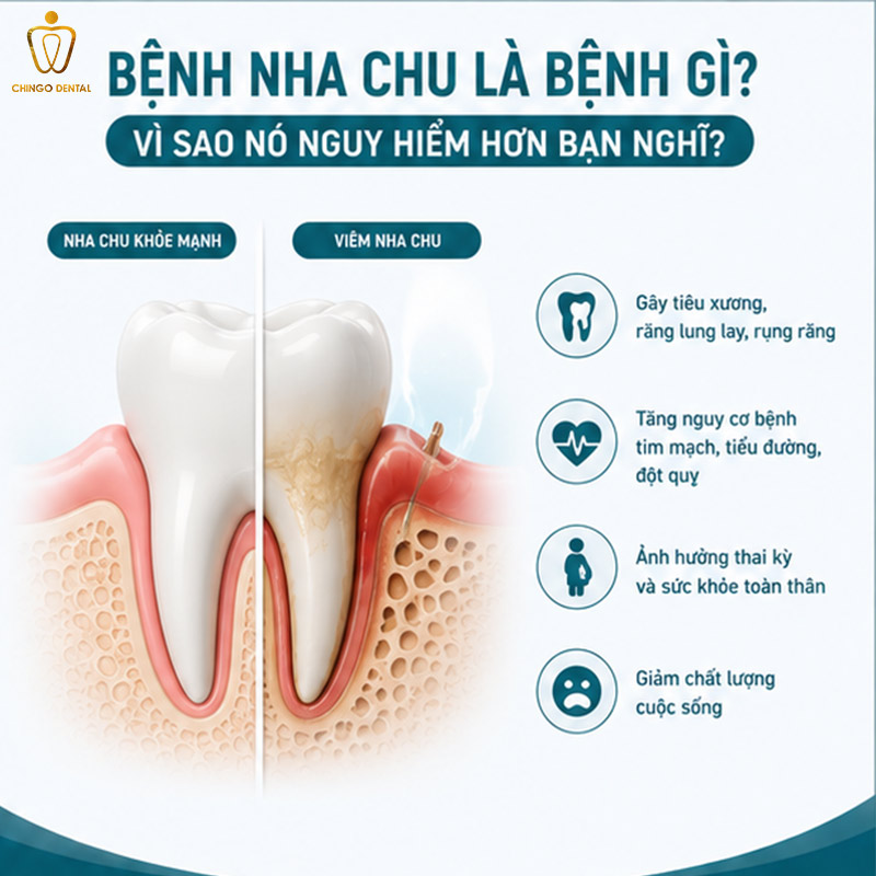 Bệnh Nha Chu Là Gì? Dấu Hiệu, Nguyên Nhân Và Cách Điều Trị Hiệu Quả 43 viêm nha chu là gì