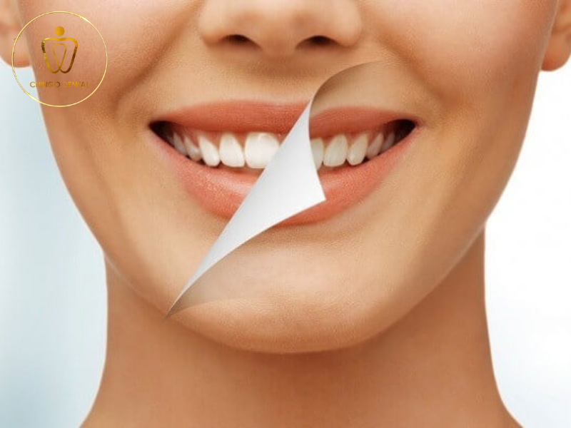 Bọc răng sứ có bền không? Tuổi thọ răng sứ là bao lâu? 3 Bọc răng sứ có bền không