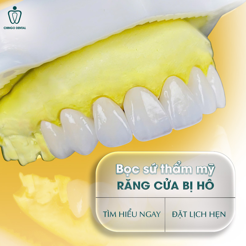 Bọc Răng Sứ 2 Răng Cửa Bị Hô – Giải Pháp Nha Khoa Hoàn Mỹ Dành Cho Người Bận Rộn 29 bọc răng sứ 2 răng cửa bị hô