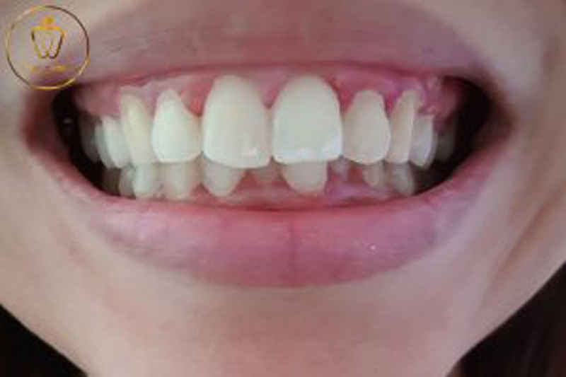 bọc răng sứ 2 răng cửa bị hô