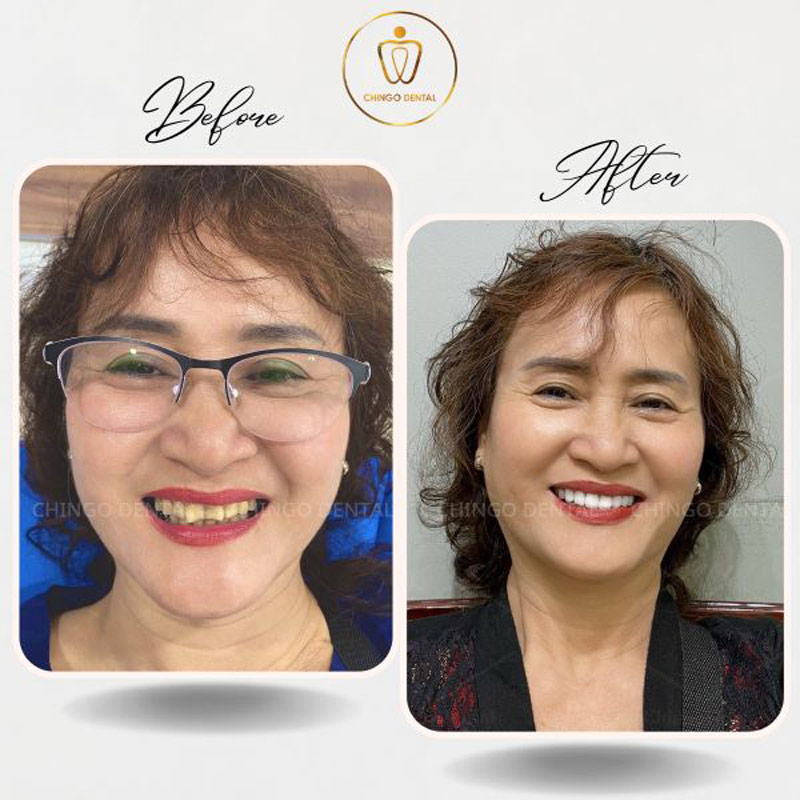 Bọc Răng Sứ Có Tốt Không? Sự Thật Về Độ Bền, Cảm Giác Đau Và Những Lưu Ý Quan Trọng 4 bọc răng sứ có bền không