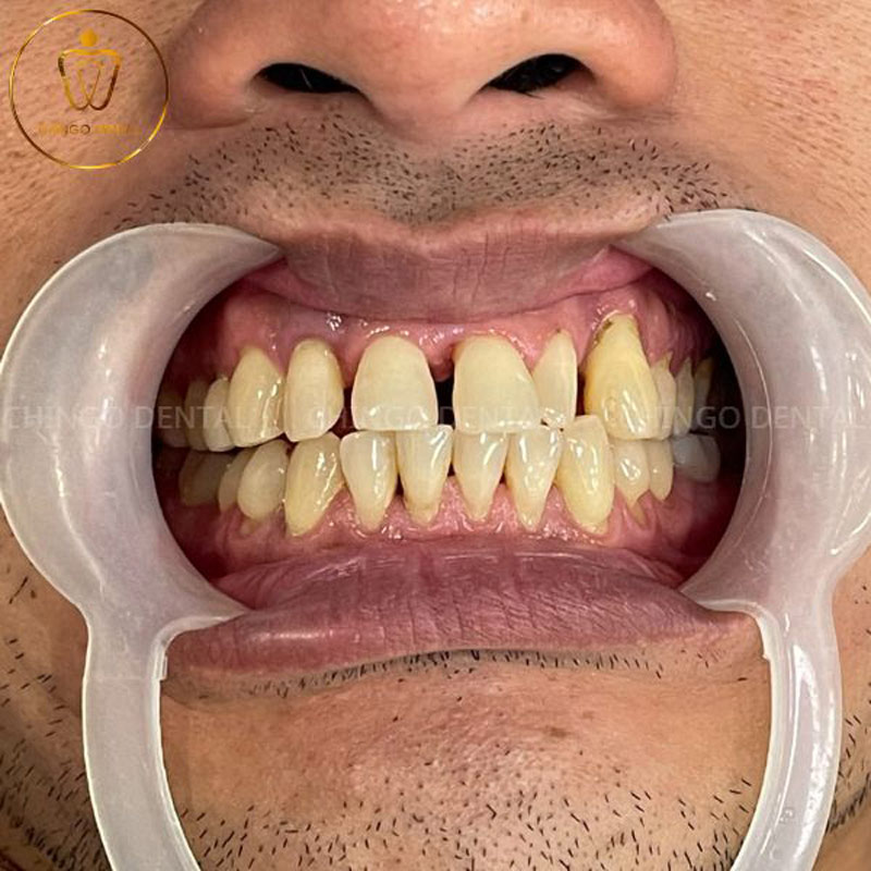 Bọc Răng Sứ Có Tốt Không? Sự Thật Về Độ Bền, Cảm Giác Đau Và Những Lưu Ý Quan Trọng 3 bọc răng sứ có tốt không