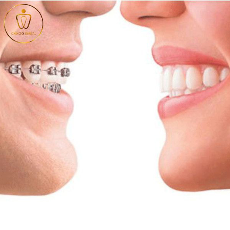 bọc sứ 2 răng cửa bị hô